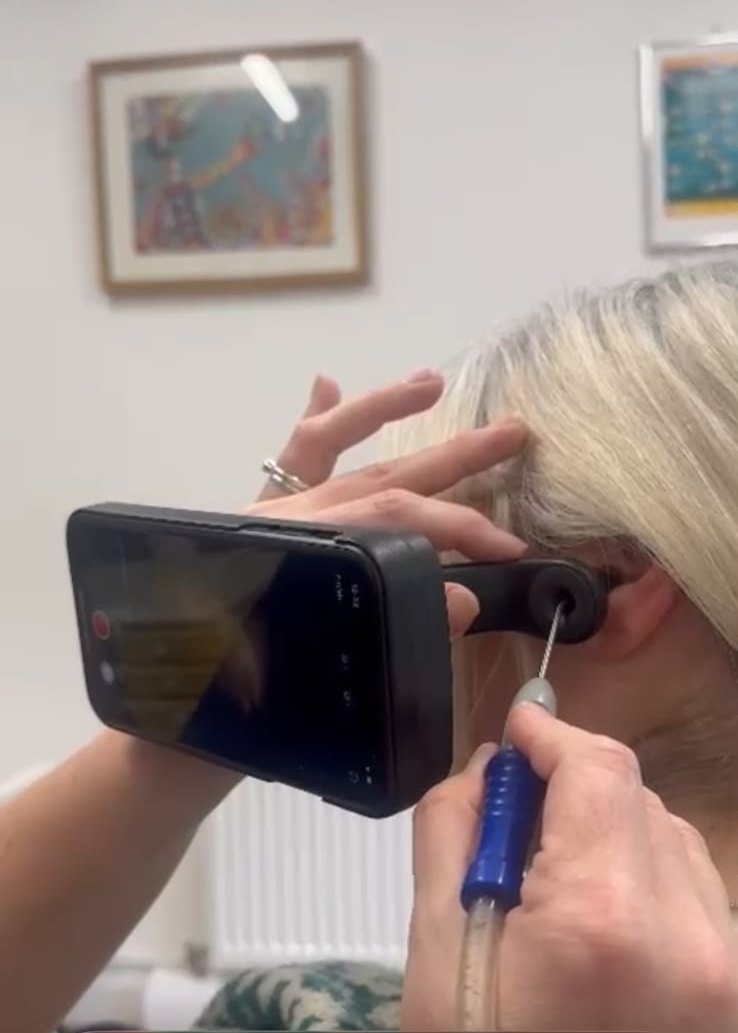 Amy carrying out microsuction: a camera held against the ear showing her what she can see, the fine suction tube in her other hand, and her hand braced against the client’s head.